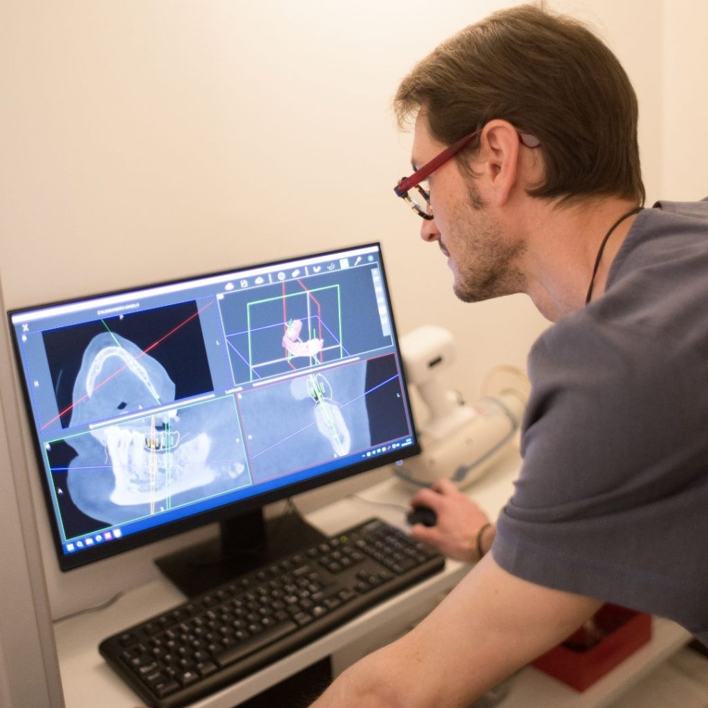 Implantologia 6 impianto dentale a Carrara