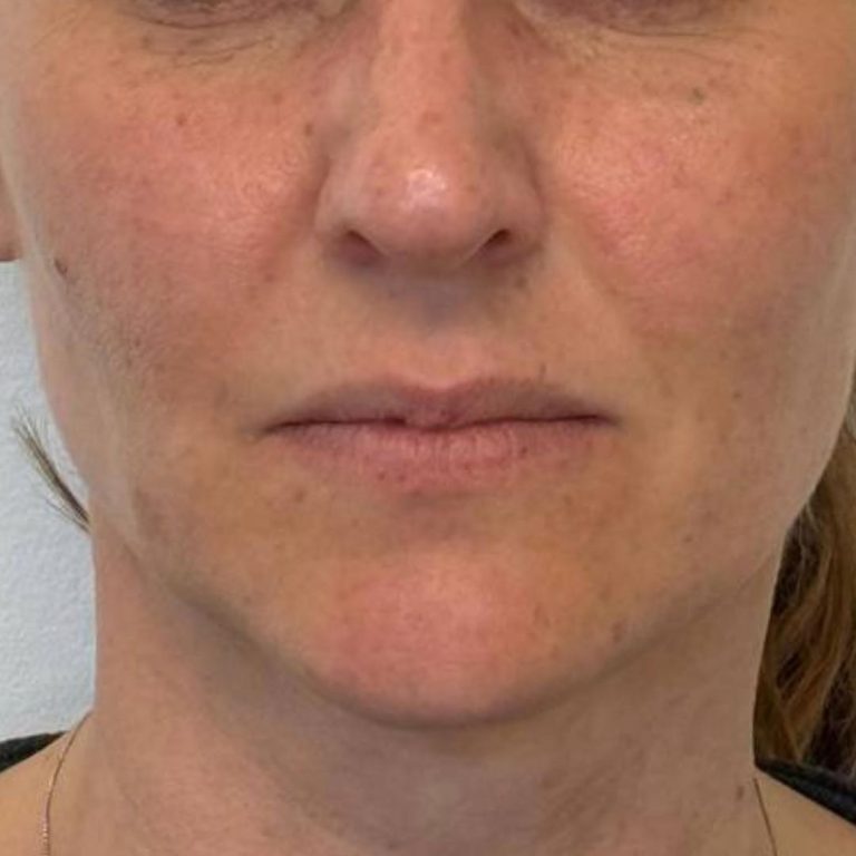 Medicina estetica 17 Romanelli-filler-labbra-prima-e-dopo-1