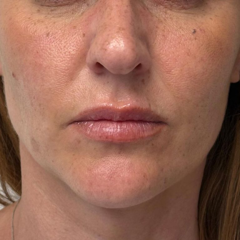 Medicina estetica 18 Romanelli-filler-labbra-prima-e-dopo-2