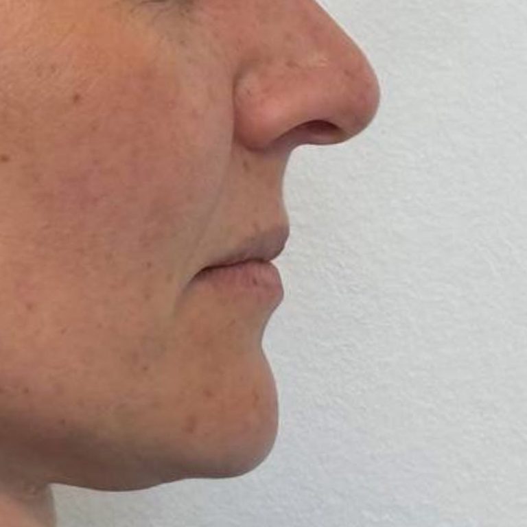 Medicina estetica 19 Romanelli-filler-labbra-prima-e-dopo-3