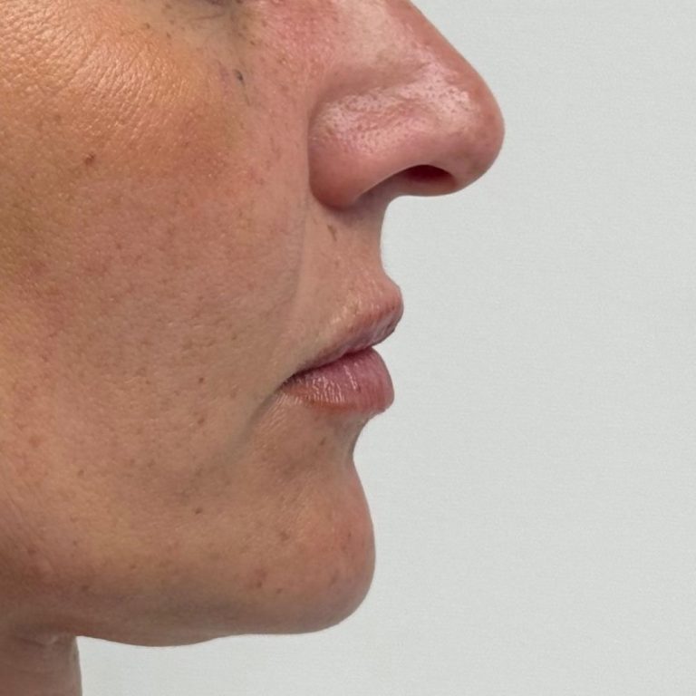 Medicina estetica 20 Romanelli-filler-labbra-prima-e-dopo-4