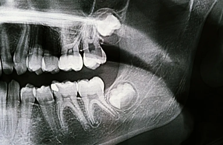 Dolore alle gengive dopo estrazione del dente del giudizio - Dolore dopo estrazione dente del giudizio