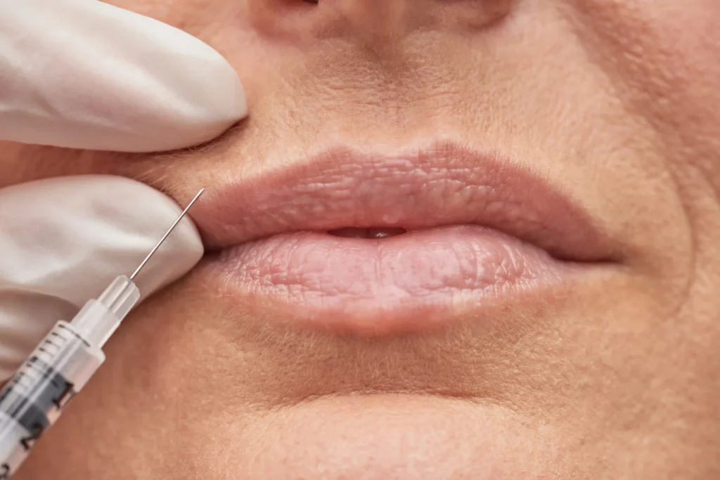 Filler labbra per rughe verticali sopra le labbra 2 filler labbra per rughe verticali