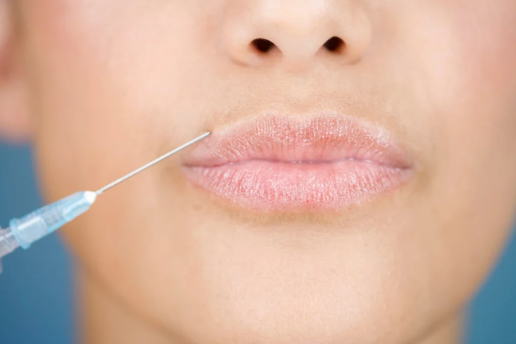 Filler labbra per rughe verticali sopra le labbra 1 filler labbra per rughe verticali