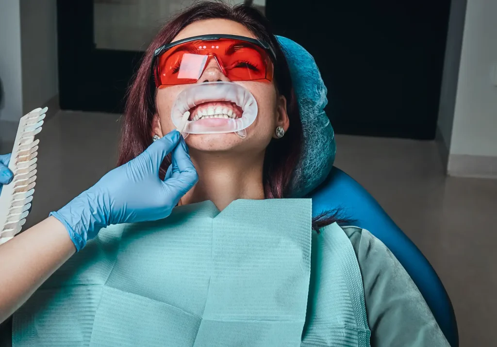 Sbiancamento dentale: prima e dopo, cosa aspettarsi 1 Sbiancamento dentale prima e dopo