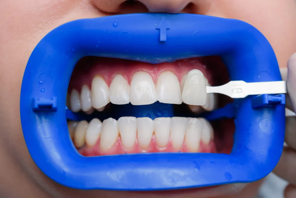 Sbiancamento dentale: prima e dopo, cosa aspettarsi 2 Sbiancamento dentale prima e dopo